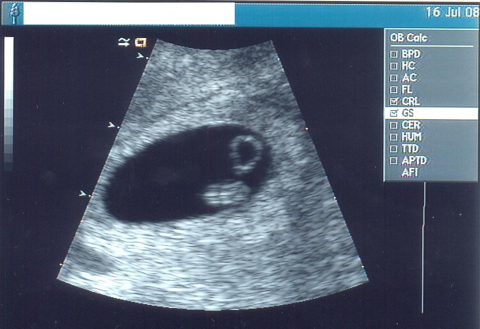 sonogram pictures sonogram pictures